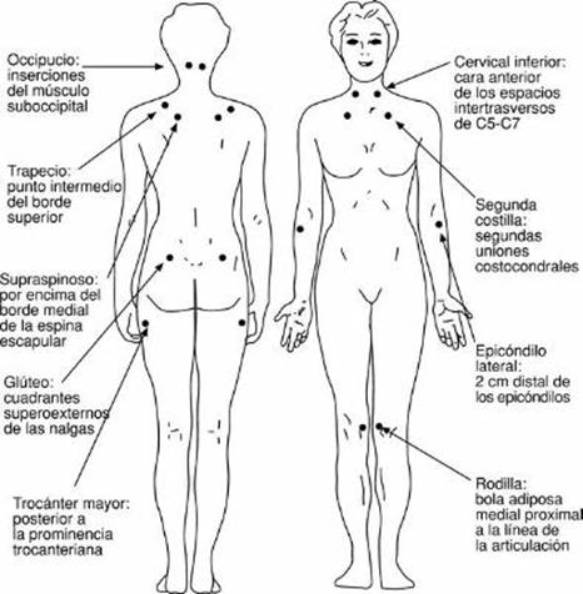 puntos fibromialgia